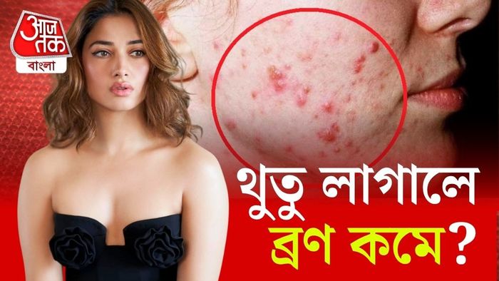 ব্রণতে থুতু লাগান তামান্না