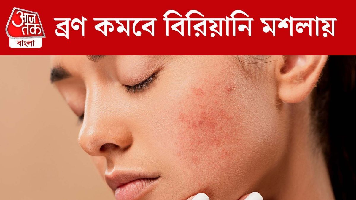 ব্রণ কমিয়ে একমাসেই ত্বক হবে উজ্জ্বল, কামাল দেখাবে বিরিয়ানি মশলা 