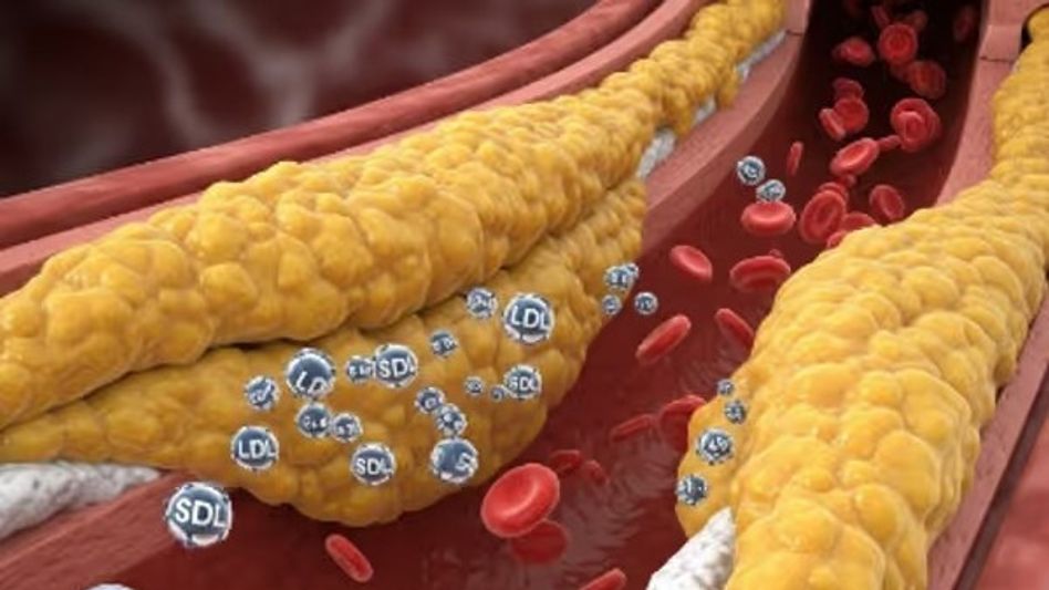 ওষুধেও উচ্চ কোলেস্টেরল কমাতে ব্যর্থ? পুষ্টিবিদ দিচ্ছেন নিশ্চিত উপায়  ওষুধেও উচ্চ কোলেস্টেরল কমাতে ব্যর্থ? পুষ্টিবিদ দিচ্ছেন নিশ্চিত উপায়