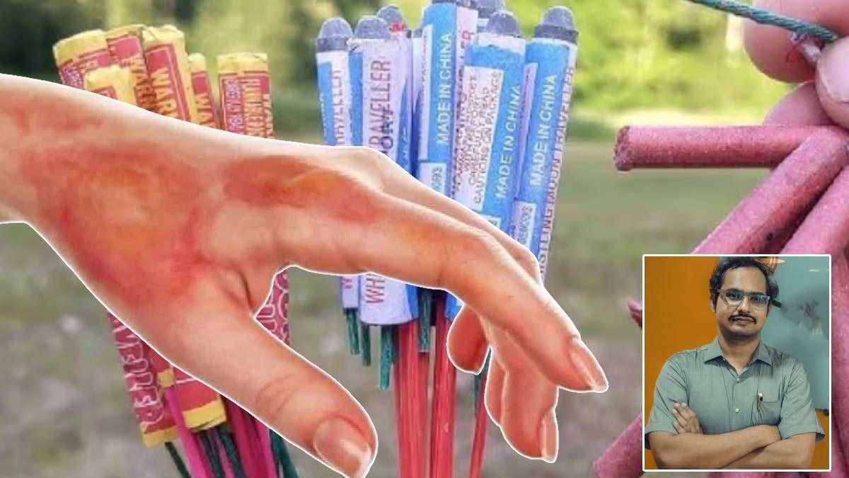 বাজিতে স্কিন পুড়লে করবেন কী? ডাক্তারের টিপস