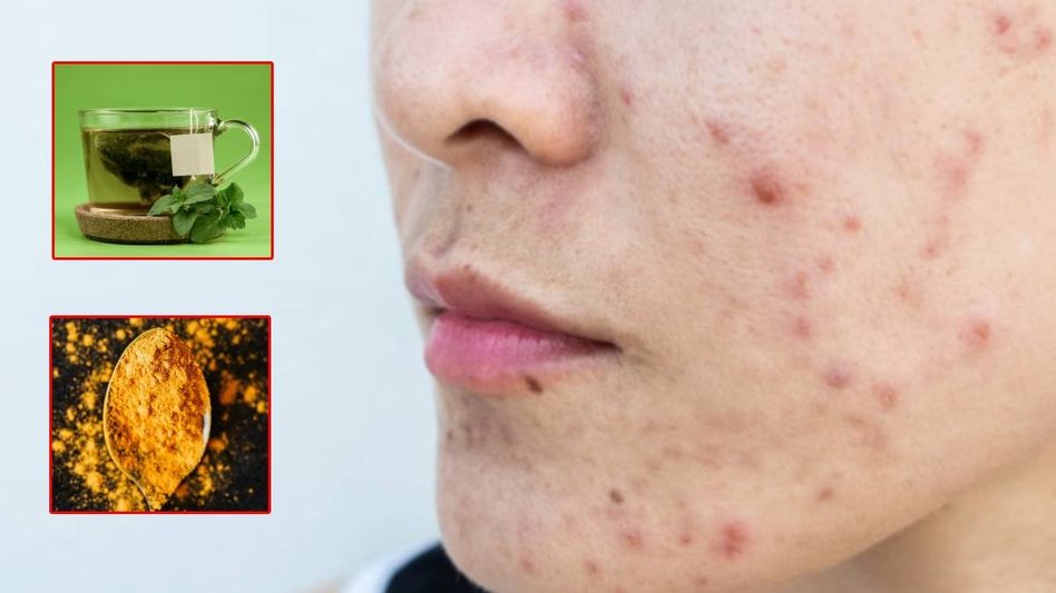 ৩ দিনে দূর হবে ব্রণর দাগ, রইল সেরা ঘরোয়া টোটকা ৩ দিনে দূর হবে ব্রণর দাগ, রইল সেরা ঘরোয়া টোটকা
