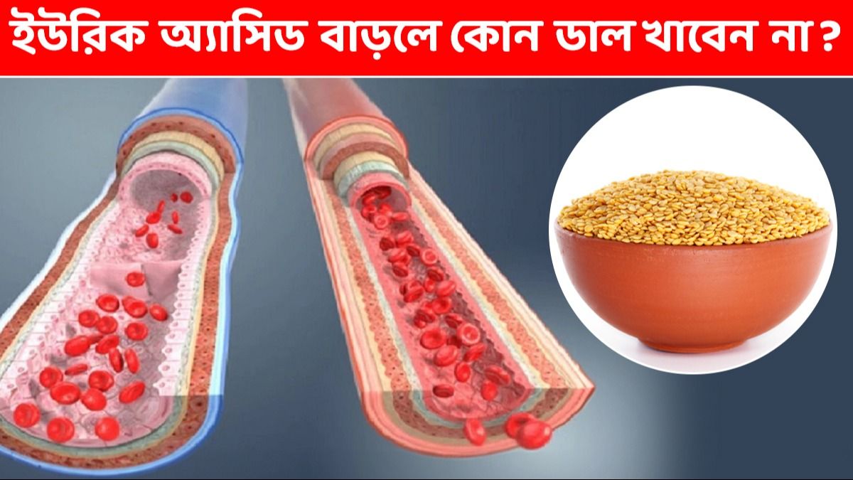 ইউরিক অ্যাসিডের মাত্রা প্রচুর বেড়েছে? জানুন, কোন কোন ডাল খাবেন না   