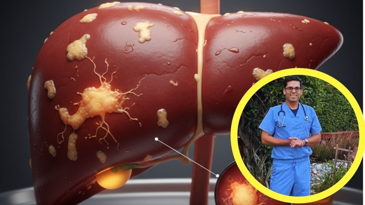 এই ৩ ড্রিঙ্কসেই সারবে ফ্যাটি লিভারের সমস্যা, বেরিয়ে আসবে জমে থাকা চর্বি