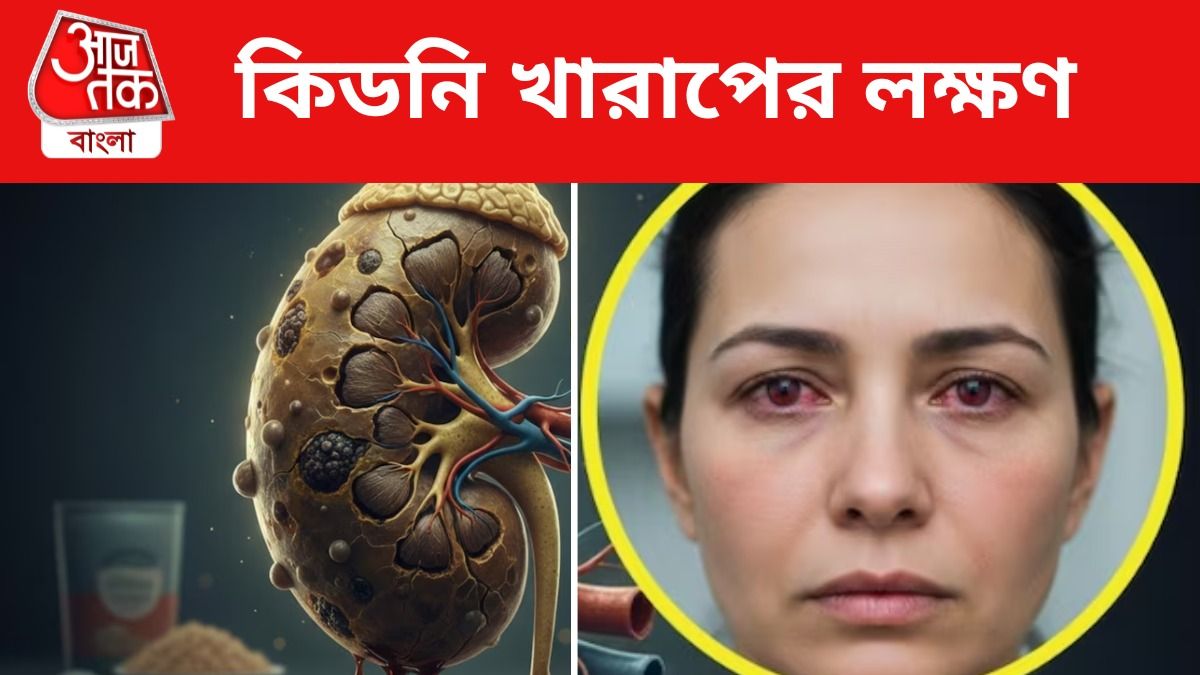 কিডনির সমস্যা হলে চোখে এ সমস্ত লক্ষণ দেখা যায়, এখনই জেনে নিন 