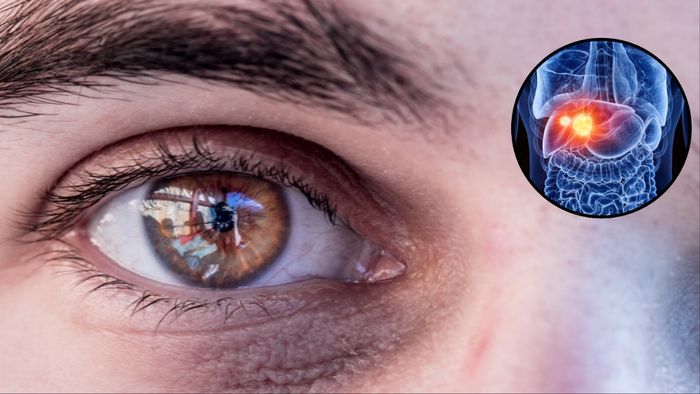 আপনার কালো দাগ কি স্বাভাবিক নাকি লিভারের ক্ষতির লক্ষণ? এভাবে চিহ্নিত করুন (ছবি- পিক্সাবে)