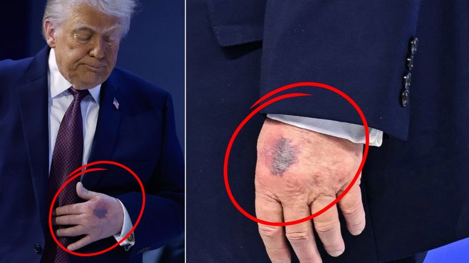 ট্রাম্পের হাতে 'কালশিটে', US প্রেসিডেন্টের কী হয়েছে? হাই ডোজের অ্যাসপিরিন ট্রাম্পের হাতে 'কালশিটে', US প্রেসিডেন্টের কী হয়েছে? হাই ডোজের অ্যাসপিরিন