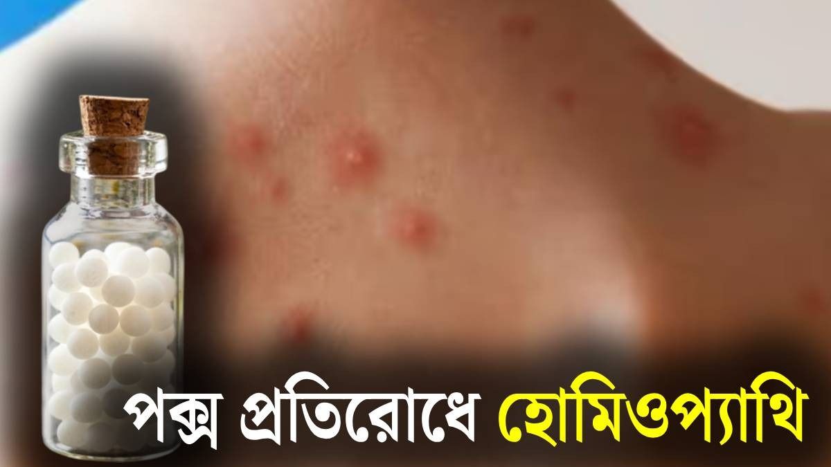 চিকেন পক্স প্রতিরোধে কী কী হোমিওপ্যাথি ওষুধ খাবেন? bangla.aajtak.in-এ লিখলেন চিকিৎসক