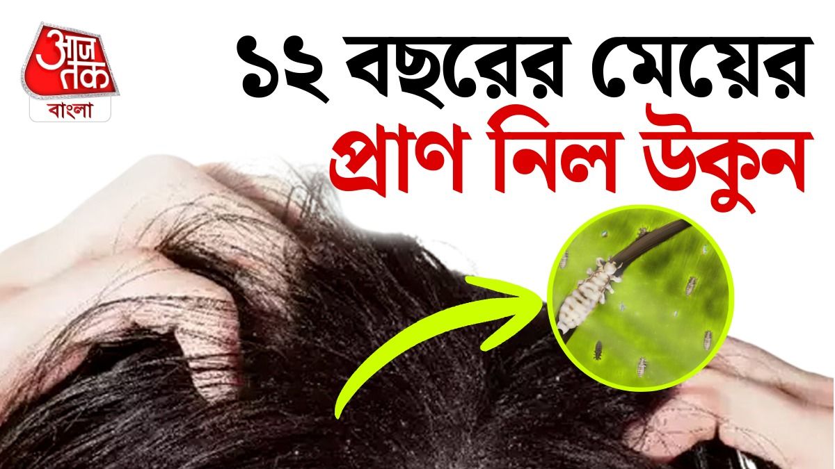 উকুনের জন্য গেল প্রাণ