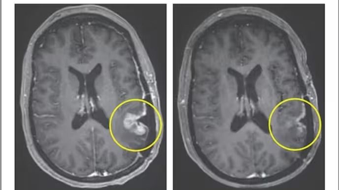  ৫ দিনেই অদৃশ্য ব্রেন টিউমার! আশা জাগাচ্ছে ক্যান্সারের নয়া ওষুধ