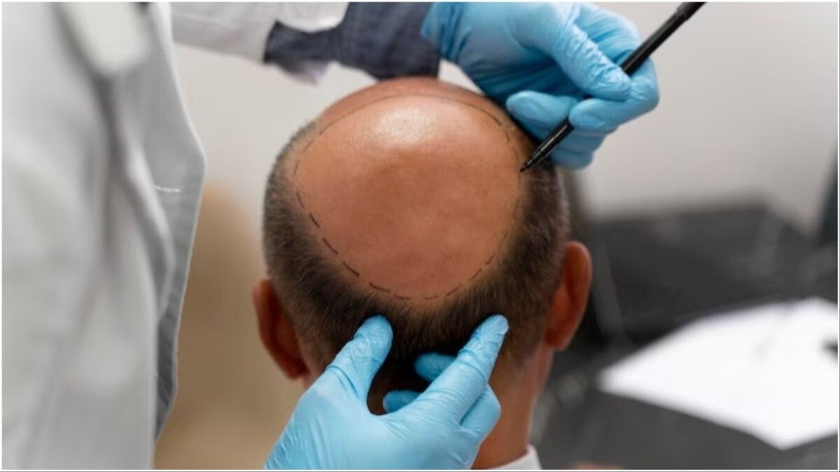 Hair Transplant Risks Snd Complications: মাথাভর্তি চুল পেতে হেয়ার ট্রান্সপ্লান্ট করাবেন? আগে জানুন সাইড এফেক্ট কতটা