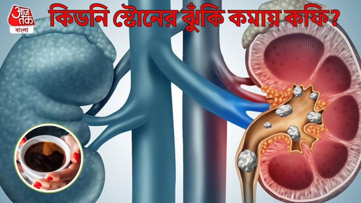 কফি খেলে কি কমে কিডনি স্টোনের ঝুঁকি? জানুন চিকিৎসকদের মত