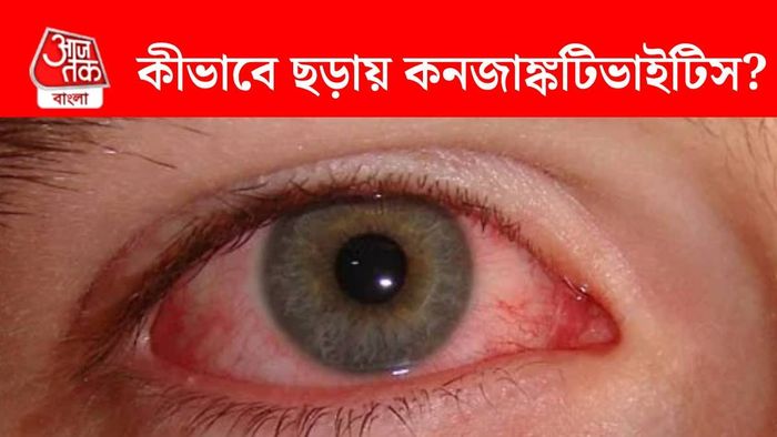 কনজাঙ্কটিভাইটিস