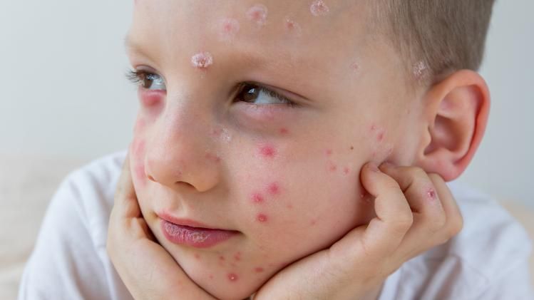 Chicken Pox Diet 