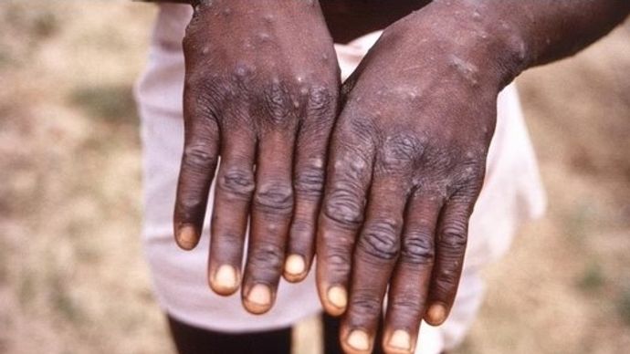 कोरोना का ख़ात्मा पूरी तरह से हुआ भी नहीं था कि अब मंकीपॉक्स महामारी का क़हर फैलने को तैयार है कोरोना का ख़ात्मा पूरी तरह से हुआ भी नहीं था कि अब मंकीपॉक्स महामारी का क़हर फैलने को तैयार है