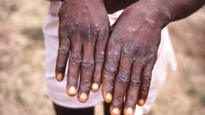 कोरोना के बाद अब Mpox का बढ़ता खौफ, देश में पहला केस मिला कोरोना के बाद अब Mpox का बढ़ता खौफ, देश में पहला केस मिला