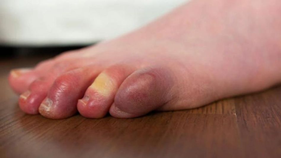 हाथ-पैरों की उंगलियों में सूजन हाथ-पैरों की उंगलियों में सूजन