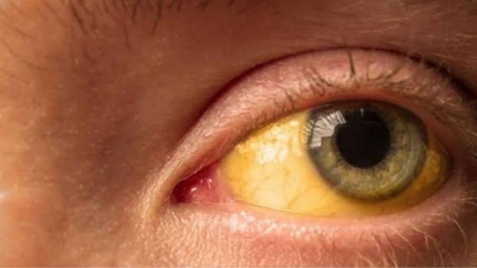 Eyes and Disease Eyes and Disease