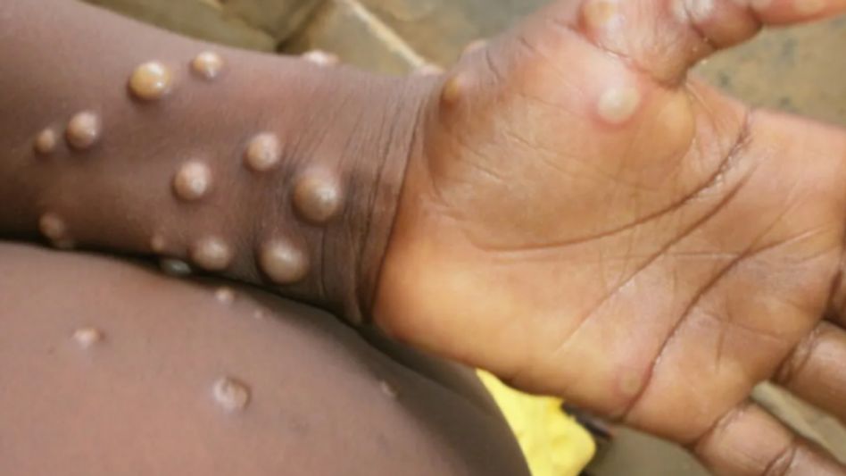 Monkeypox (Credit: who.int) Monkeypox (Credit: who.int)