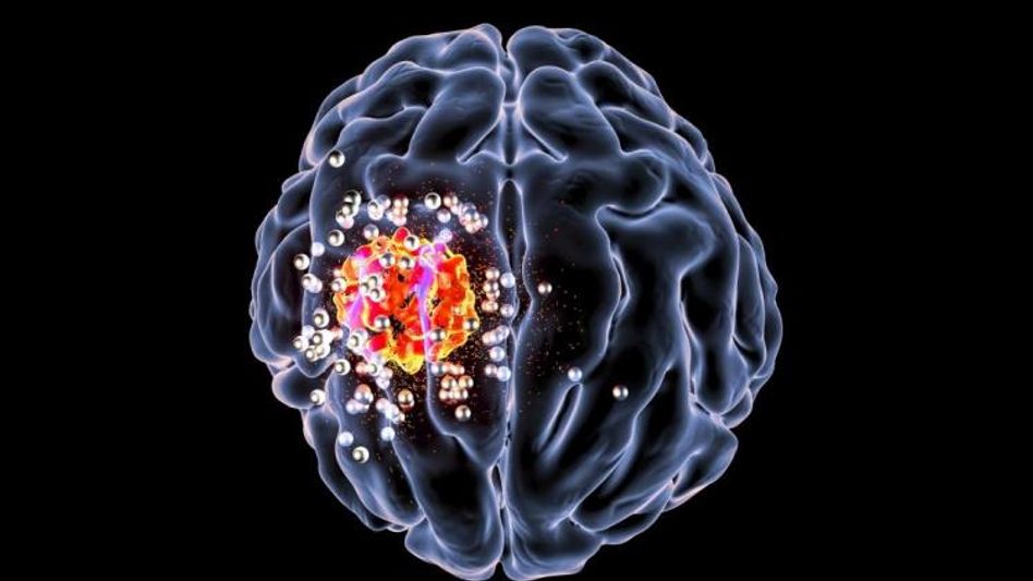 brain cancer treatment  brain cancer treatment