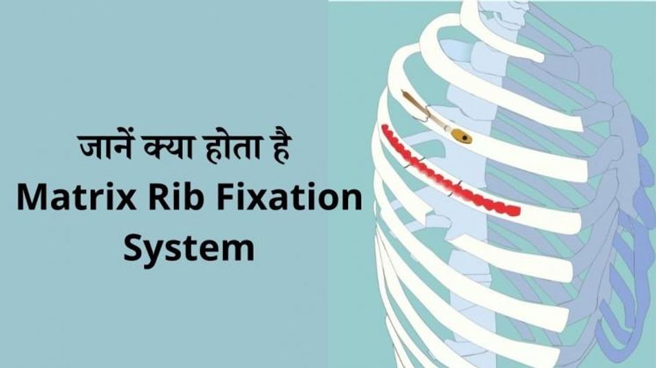 Matrix Rib Fixation System Matrix Rib Fixation System