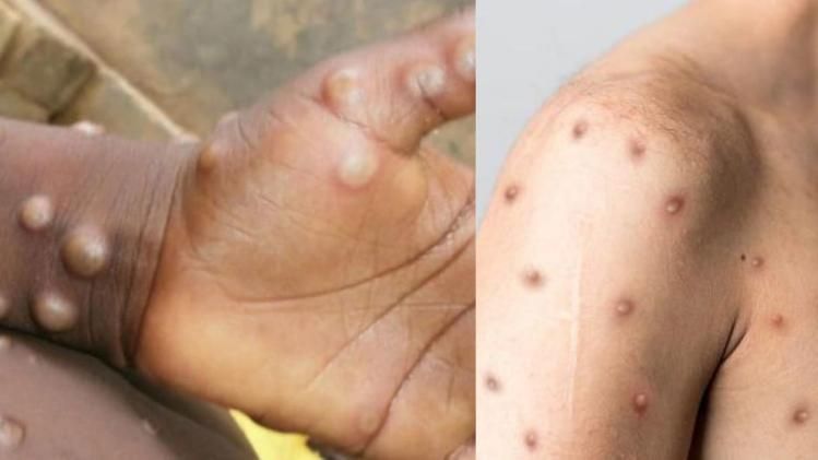 भारत में कुल मंकीपॉक्स मरीजों की संख्या हुई दो 