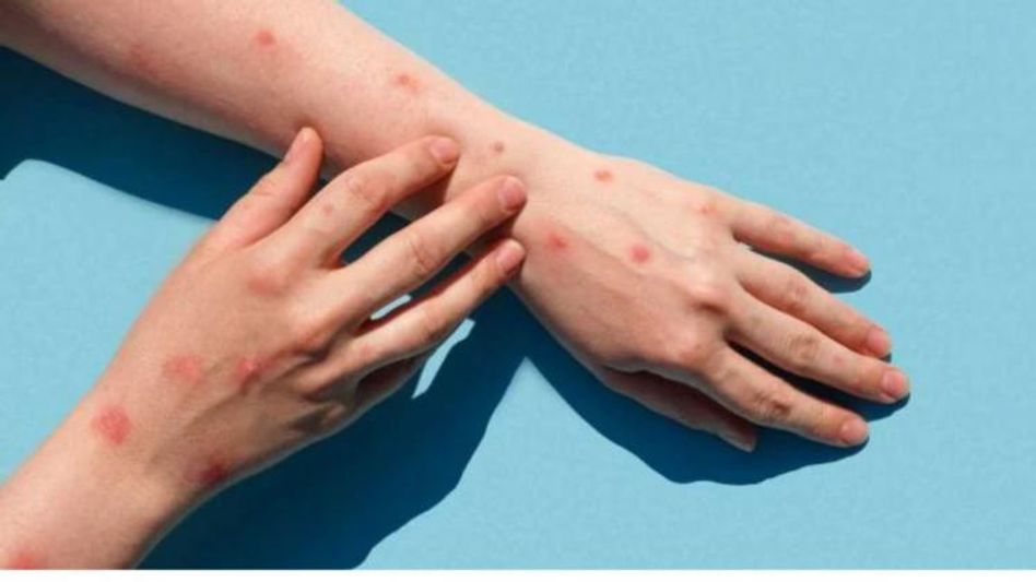 मंकीपॉक्स मंकीपॉक्स