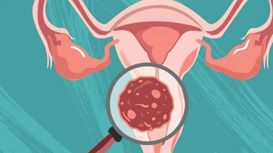 सर्वाइकल कैंसर सर्वाइकल कैंसर