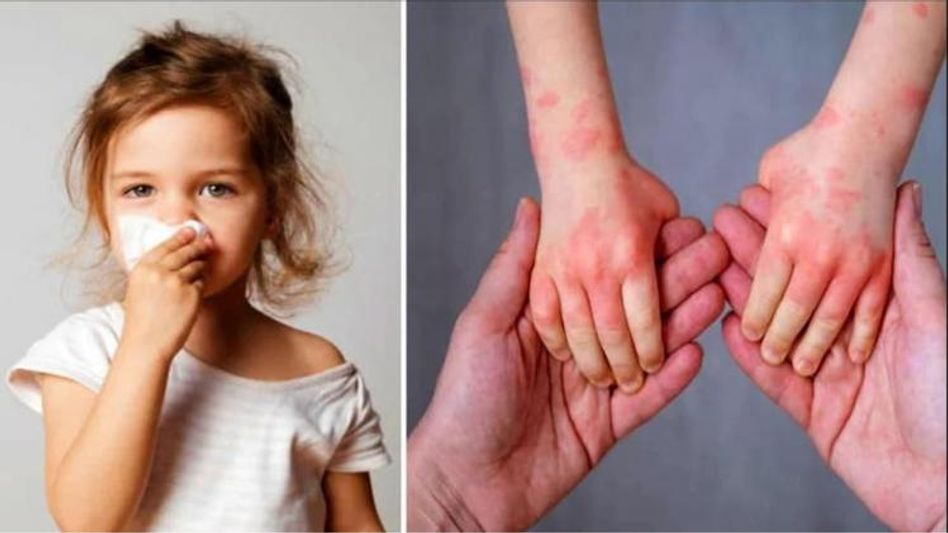 Know About Tomato Flu Causes, symptoms, prevention Know About Tomato Flu Causes, symptoms, prevention