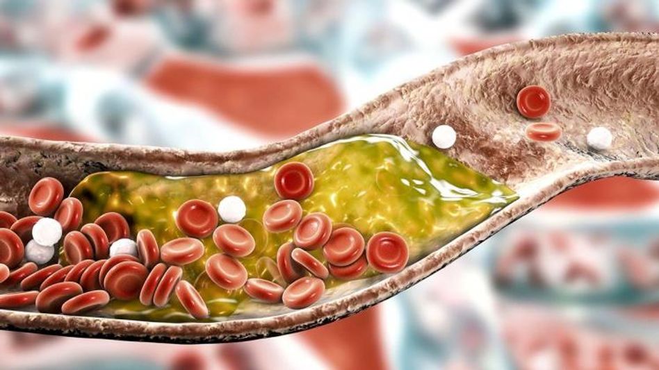 How to Reduce Bad Cholesterol How to Reduce Bad Cholesterol