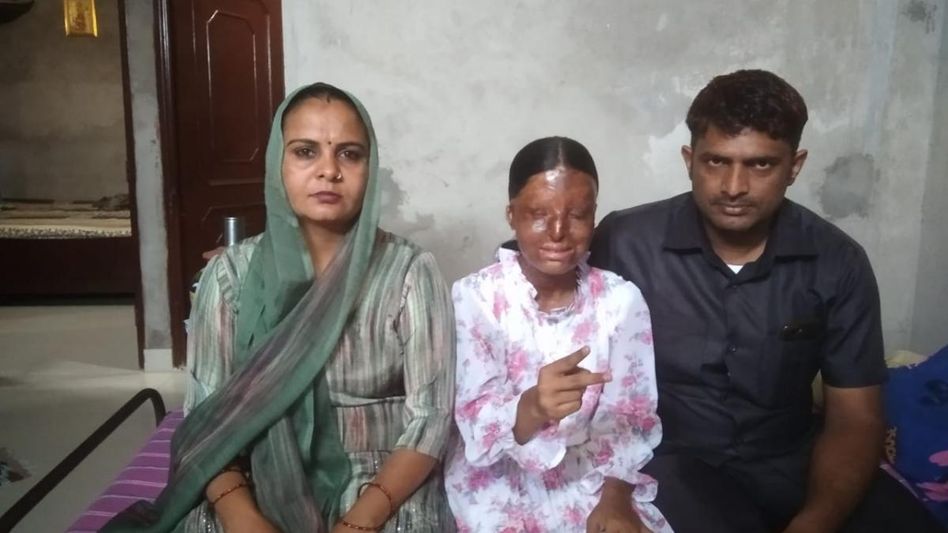 Kafi, acid attack survivor Kafi, acid attack survivor