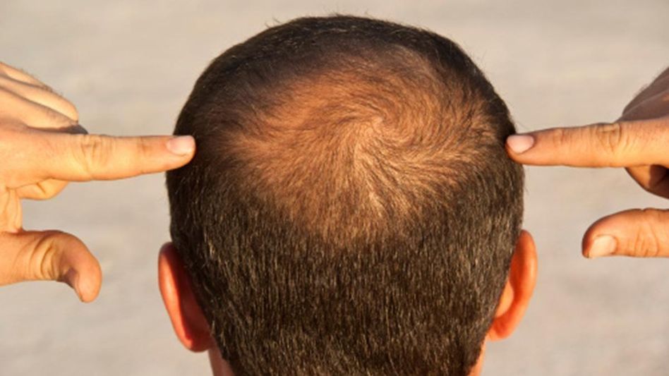 Therapy for Hair loss Therapy for Hair loss