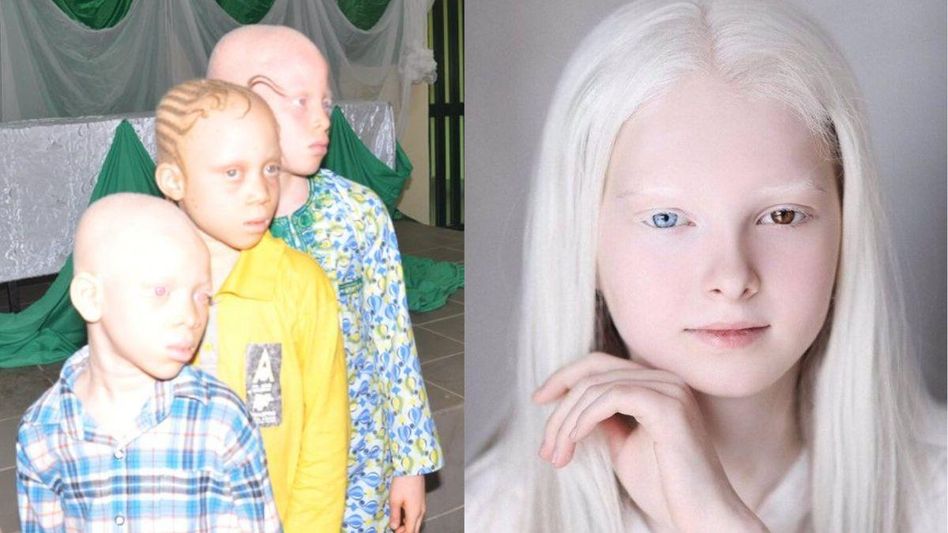 ऐल्बिनिज्म से पीड़ित बच्चे (फोटो ट्विटर) ऐल्बिनिज्म से पीड़ित बच्चे (फोटो ट्विटर)