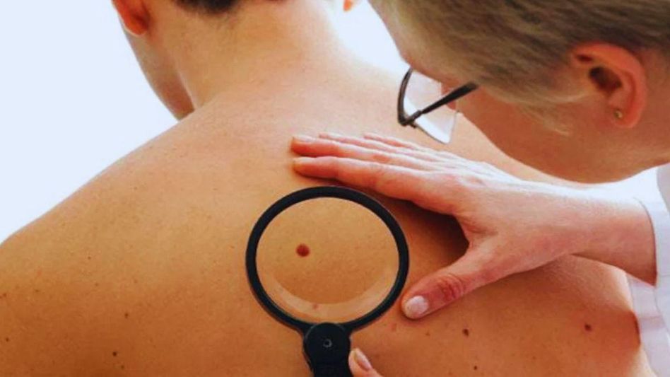 Skin Cancer Skin Cancer