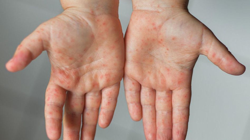Hand, Foot and Mouth Disease Hand, Foot and Mouth Disease
