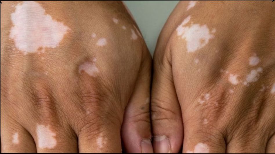 vitiligo vitiligo