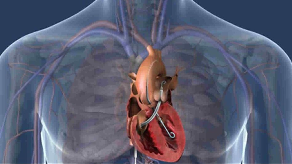 Impella device and Heart Impella device and Heart