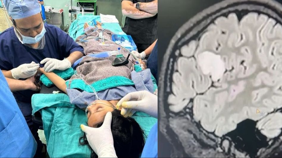 Awake Brain Tumor Surgery in AIIMS Awake Brain Tumor Surgery in AIIMS