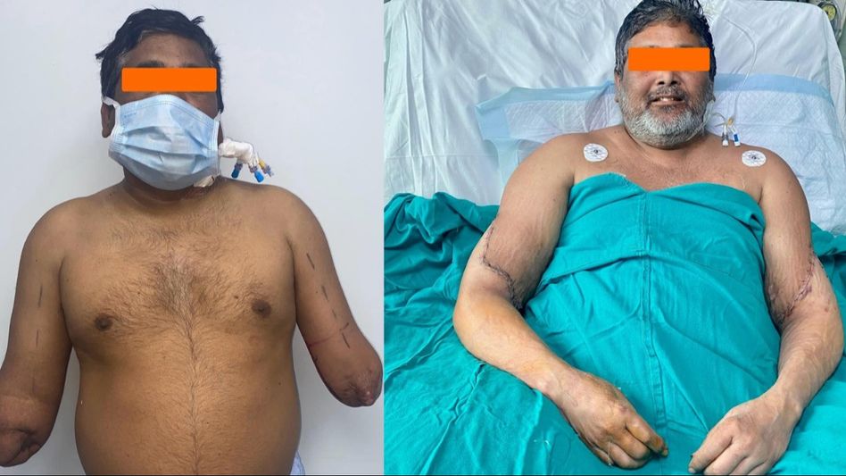 Delhi's first Bilateral Hand Transplant Delhi's first Bilateral Hand Transplant