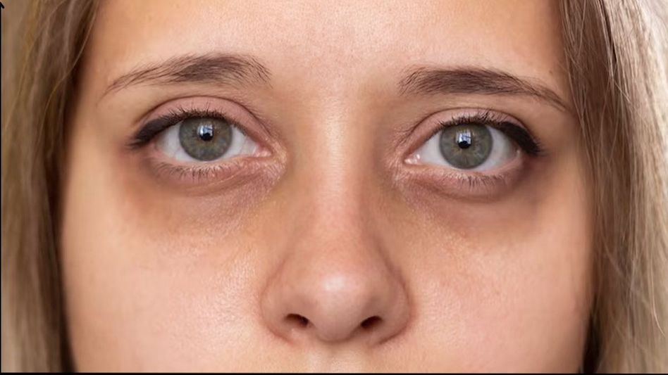Thyroid Eye Disease Thyroid Eye Disease