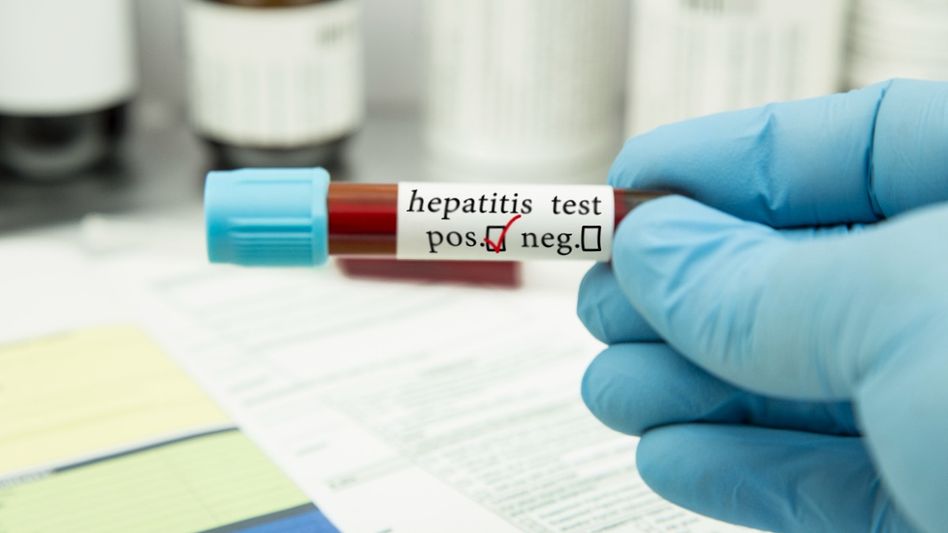Hepatitis test in the laboratory (Photo: Getty Images) Hepatitis test in the laboratory (Photo: Getty Images)