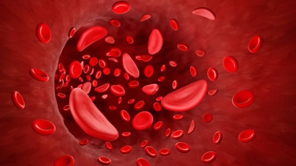 Anaemia Symptoms (Photo/Getty Images) Anaemia Symptoms (Photo/Getty Images)