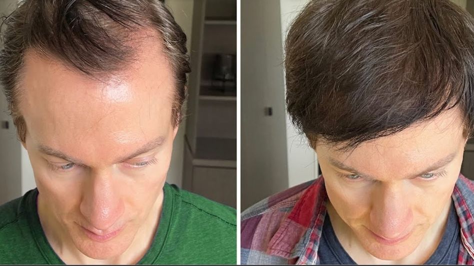 Bryan Johnson reversed his hair loss Bryan Johnson reversed his hair loss