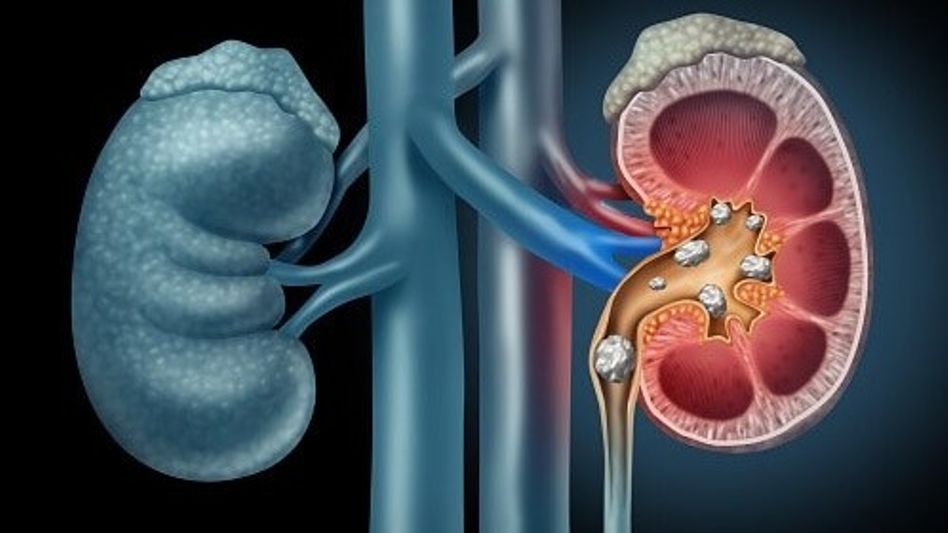 Weight loss drugs can improve kidney health Weight loss drugs can improve kidney health