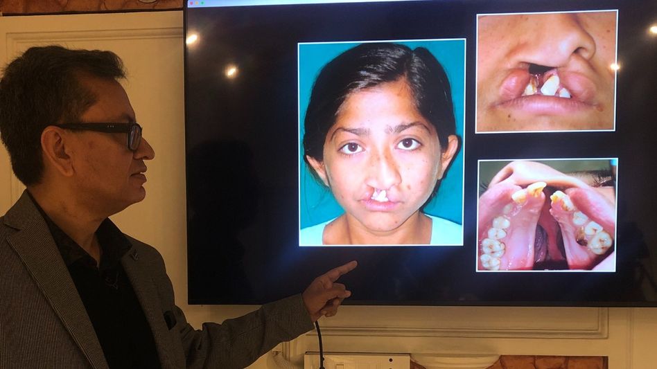 Treating cleft lip and palate Treating cleft lip and palate
