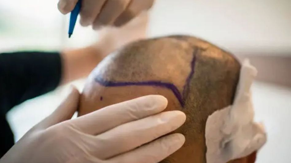 Hair Transplant Risks (Representative Image/Unsplash) Hair Transplant Risks (Representative Image/Unsplash)