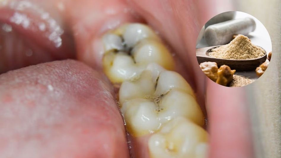 Tooth Cavities Tooth Cavities