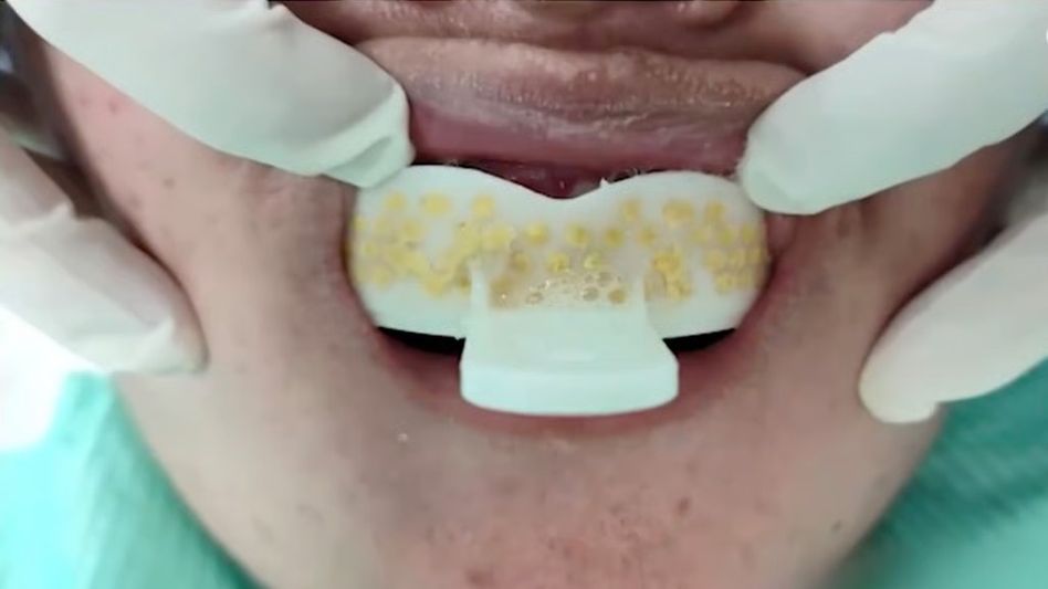 Home Dental Treatment Gone Wrong Home Dental Treatment Gone Wrong