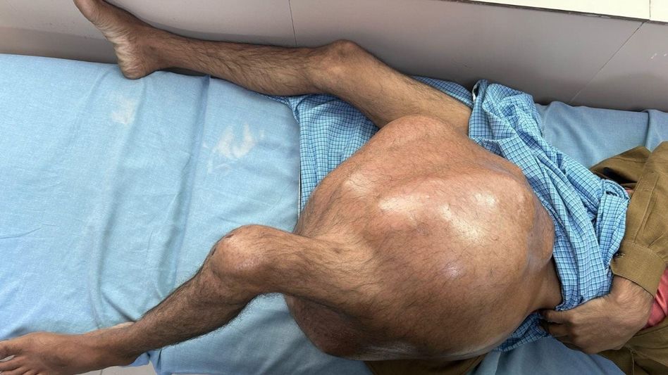 35 kg tumor removed 35 kg tumor removed