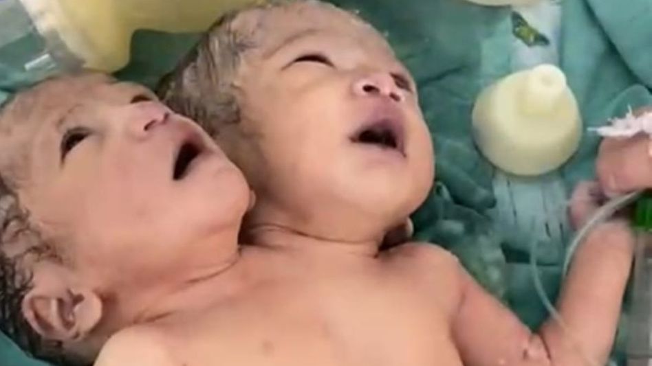 Two Headed Baby Two Headed Baby