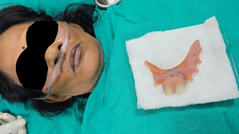 Denture Gets Stuck in Woman Throat Denture Gets Stuck in Woman Throat